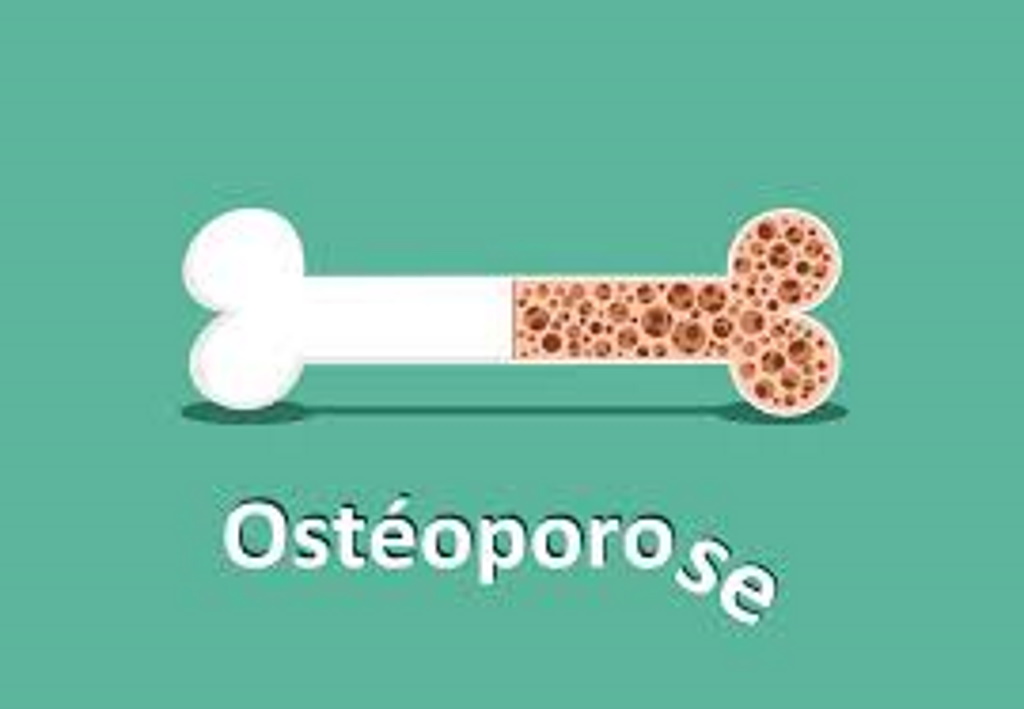 DÉPISTAGE ORGANISÉ DE L’OSTÉOPOROSE